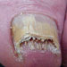 Many nails involved, whole nail involved with nail crumbling, pain
