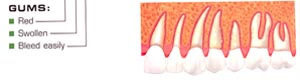 Gingivitis early reversible periodontal disease