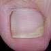 Mild Fungal Nail Infection