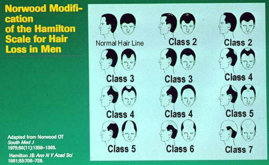 Norwood Classification of Male Pattern Baldness - Propecia