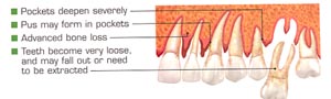 Periostat prescription:  severe periodontitis